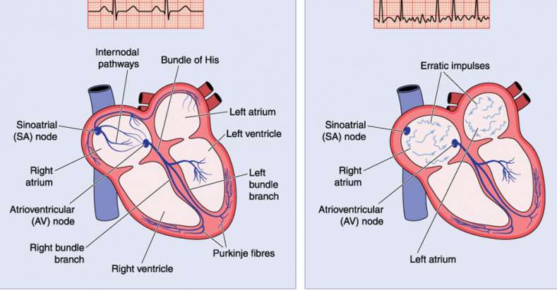 Pediatric Arrhythmia: Symptoms, Causes & Treatments - RCHI Blog